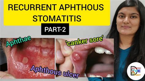 RECURRENT APHTHOUS STOMATITIS (RAS) PART- 2 - YouTube