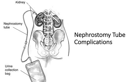 emDOCs.net – Emergency Medicine EducationComplications of Nephrostomy Tubes: ED Presentations ...