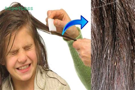 How To Remove Nits From Hair Without A Comb - bSpotLess