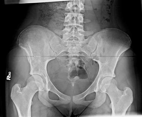 Osteosarcoma of the iliac crest - Body MR Case Studies - CTisus CT Scanning