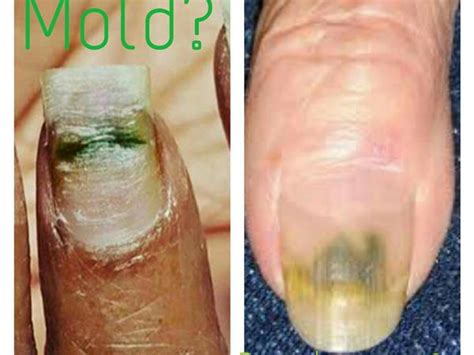 Green Fungus On Nails - Nail Fungus Information Prevention And Treatment Disabled World : I look ...