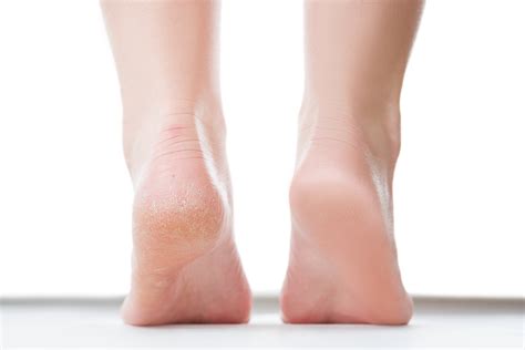 Foot Treatments That May Heal Dry And Cracked Skin For Good, 42% OFF