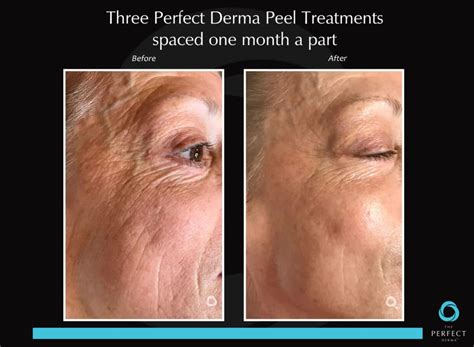 The Perfect Derma Peel - My Face Lady