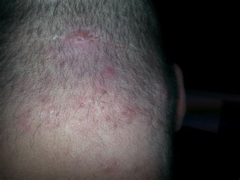 Spots And Boil Type Things On The Back Of My Neck. - General acne discussion - Acne.org