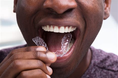 10 Clear Aligner Facts From an Orthodontist – Dental Arts NOLA
