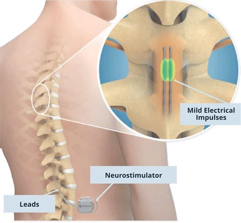 Spinal Column and Peripheral Nerve Stimulator - Back Pain Treatment