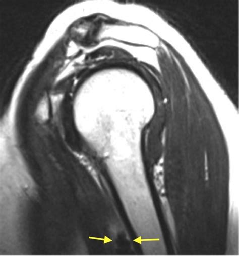 Management of Calcific Tendinitis of the long head of biceps – Lessons learned | Karthik ...