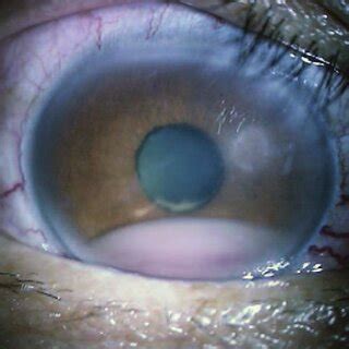 The slit-lamp photographs showed blood-streak hypopyon in the right eye. | Download Scientific ...