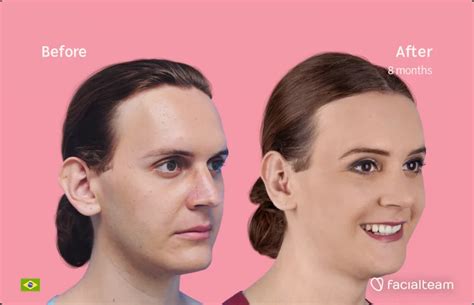 Adam’s Apple Reduction vs. Voice Feminization — Facialteam