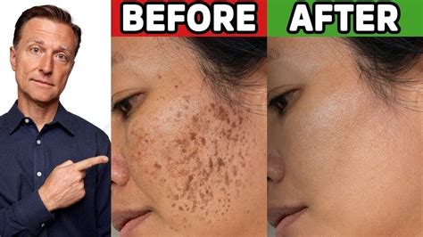 How to Get Rid of Hyperpigmentation (Aging or Dark Spots) - YouTube