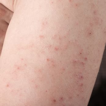 Rashes That Come and Go: 5 Possible Causes and Corresponding Treatments | New Health Advisor