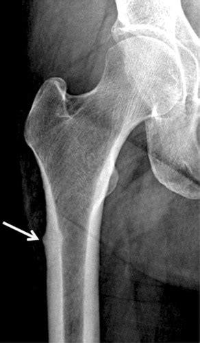 Osteoporosis Imaging: State of the Art and Advanced Imaging | Radiology