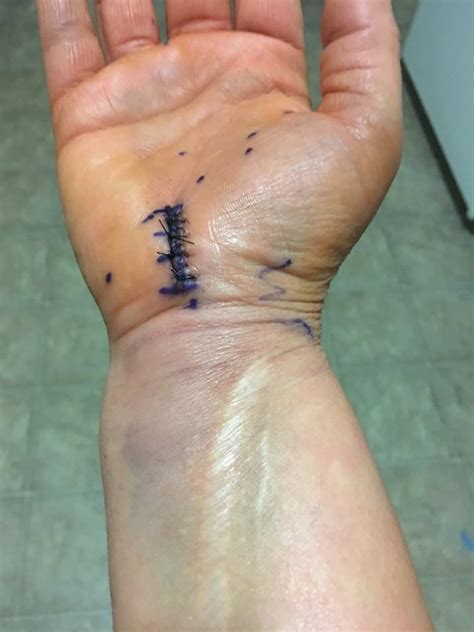 Carpal Tunnel Surgery Recovery: 3 Months Later - 24/7 Modern Mom ...