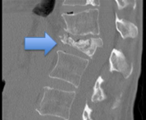 Compression Fracture Lumbar