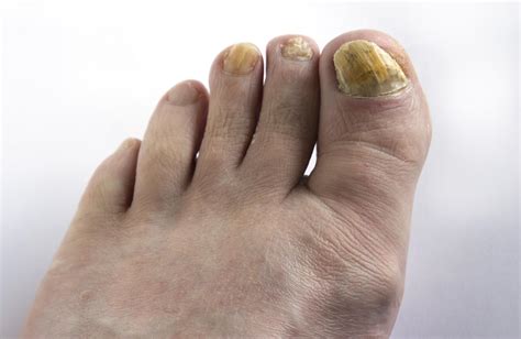 Toenail Problems: Fungus, Thickening & Yellow Toenails