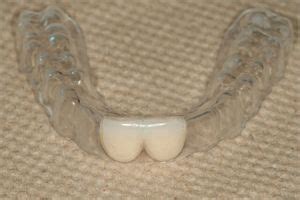 Essix retainer replacing front two upper incisors | Dental retainer, Essix retainer, Dental