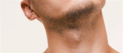 Neck hair removal | Laser hair removal for men | Solution Clinic