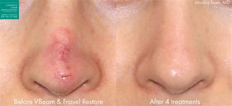 Fraxel Re:store Laser Medical Spa | San Diego, CA | CLDerm