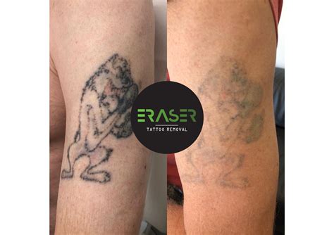 Home - Eraser Tattoo Removal