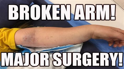 BROKEN ARM IN 4 PLACES ~ NEEDS MAJOR SURGERY - YouTube