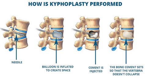 Kyphoplasty procedure, how kyphoplasty is done and kyphoplasty risks