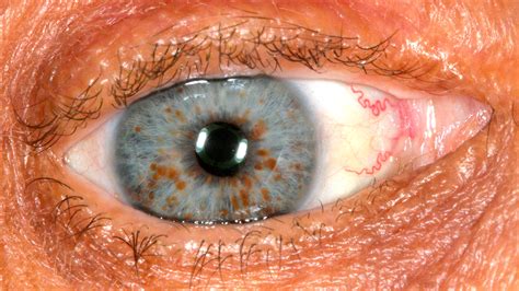 Neurofibromatosis Type 1 Eye