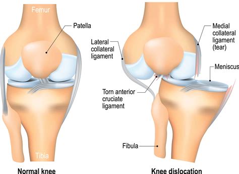 Dislocated Knee | Hartford Hospital | Hartford, CT