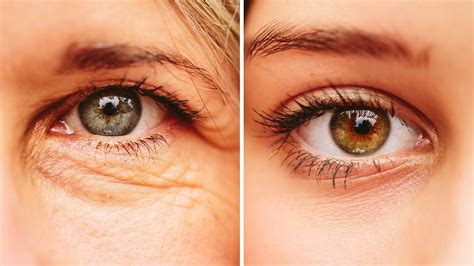 Natural Remedy For Sagging Eyelids You Will See Results In 2 Minutes