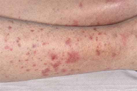 Allergic vasculitis - Stock Image - C049/8696 - Science Photo Library