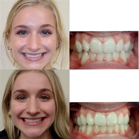 Before & After Invisalign | Wazio Orthodontics