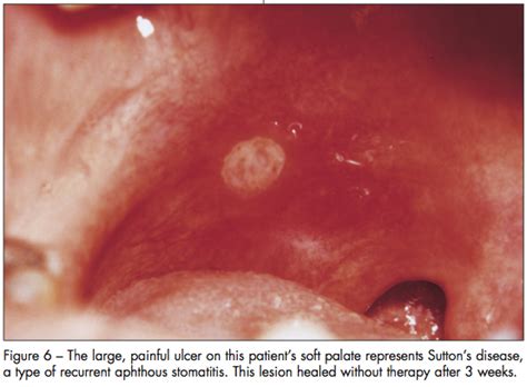 Canker Sore On Soft Palate