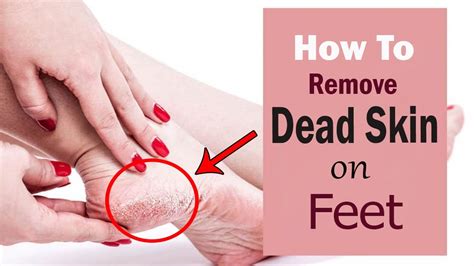 How to Remove Dead Skin on Your Feet at Home || Home Remedies for Dead ...