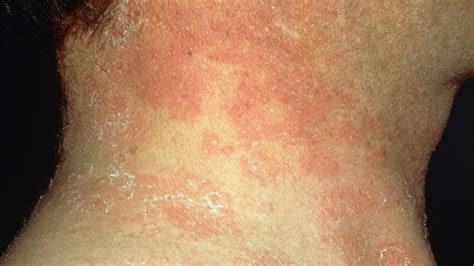 What Causes Red Spots On Skin
