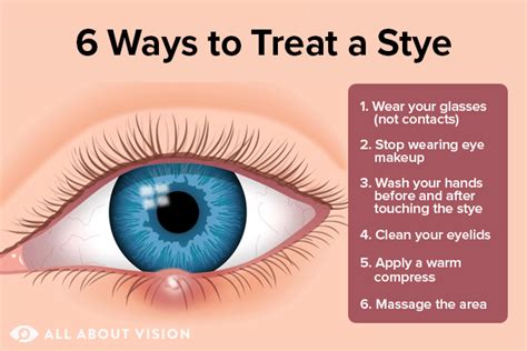 Stye Treatment: How To Get Rid of a Stye