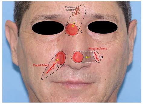 JCM | Free Full-Text | Locoregional Flaps for the Reconstruction of Midface Skin Defects: A ...