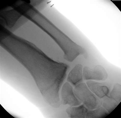 Essex-Lopresti fracture-dislocation