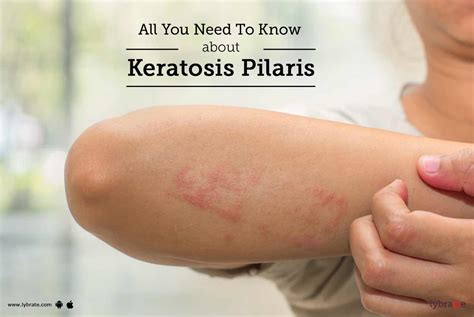 Keratosis Pilaris In Children Symptoms Causes And Tre - vrogue.co