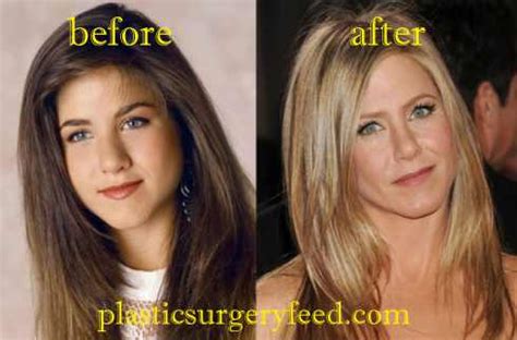 Jennifer Aniston Botox - Plastic Surgery Feed