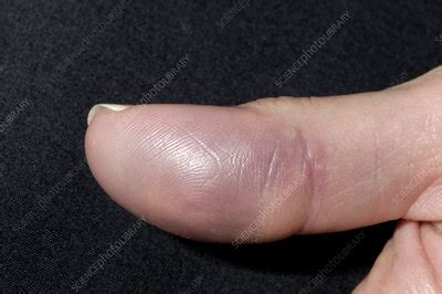 Fractured thumb - Stock Image - M330/1515 - Science Photo Library