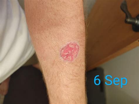 Progress of melanoma removal : r/Melanoma