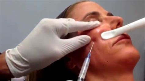 Sculptra: Procedimento, Benefícios E Cuidados Pós-Tratamento