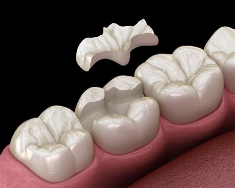 Dental Inlays/Onlays - Eastern Dental