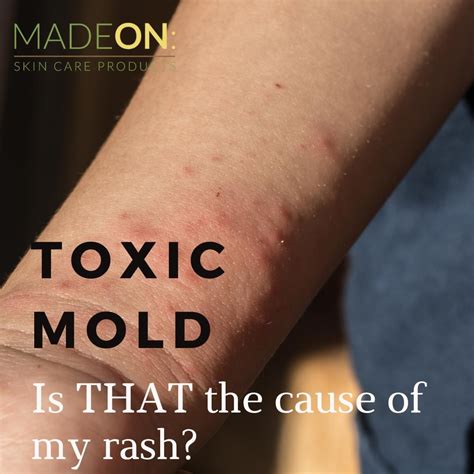 Symptoms of Toxic Mold Exposure - MadeOn Skin Care