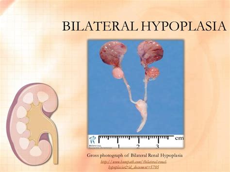 Renal Hypoplasia FINAL OUTPUT by Nica Valencia