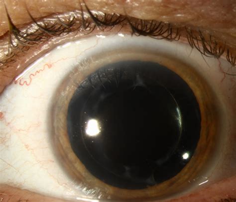 Cataract, It's causes, treatment and Cataract Surgery - Eye Health Nepal