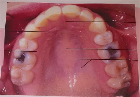 Surface features of the hard palate Diagram | Quizlet