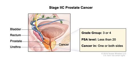 Prostate Cancer Treatment - NCI