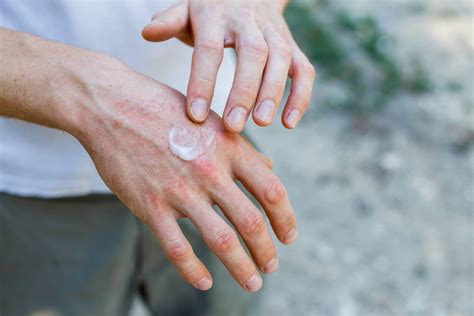 Effective Naturopathic Eczema Care at Neurvana Health Calgary