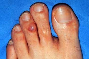 Lump On Toe: Causes & Treatment For Toe Lumps & Bumps