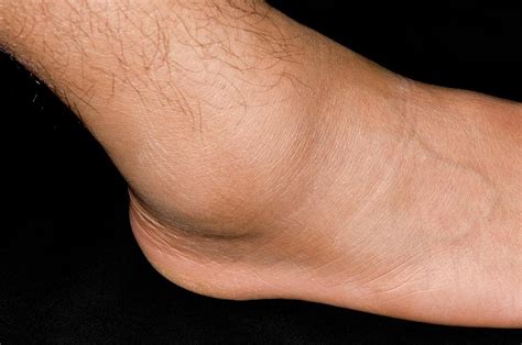 Sprained Ankle Sport's Injury Photograph by Dr P. Marazzi/science Photo Library